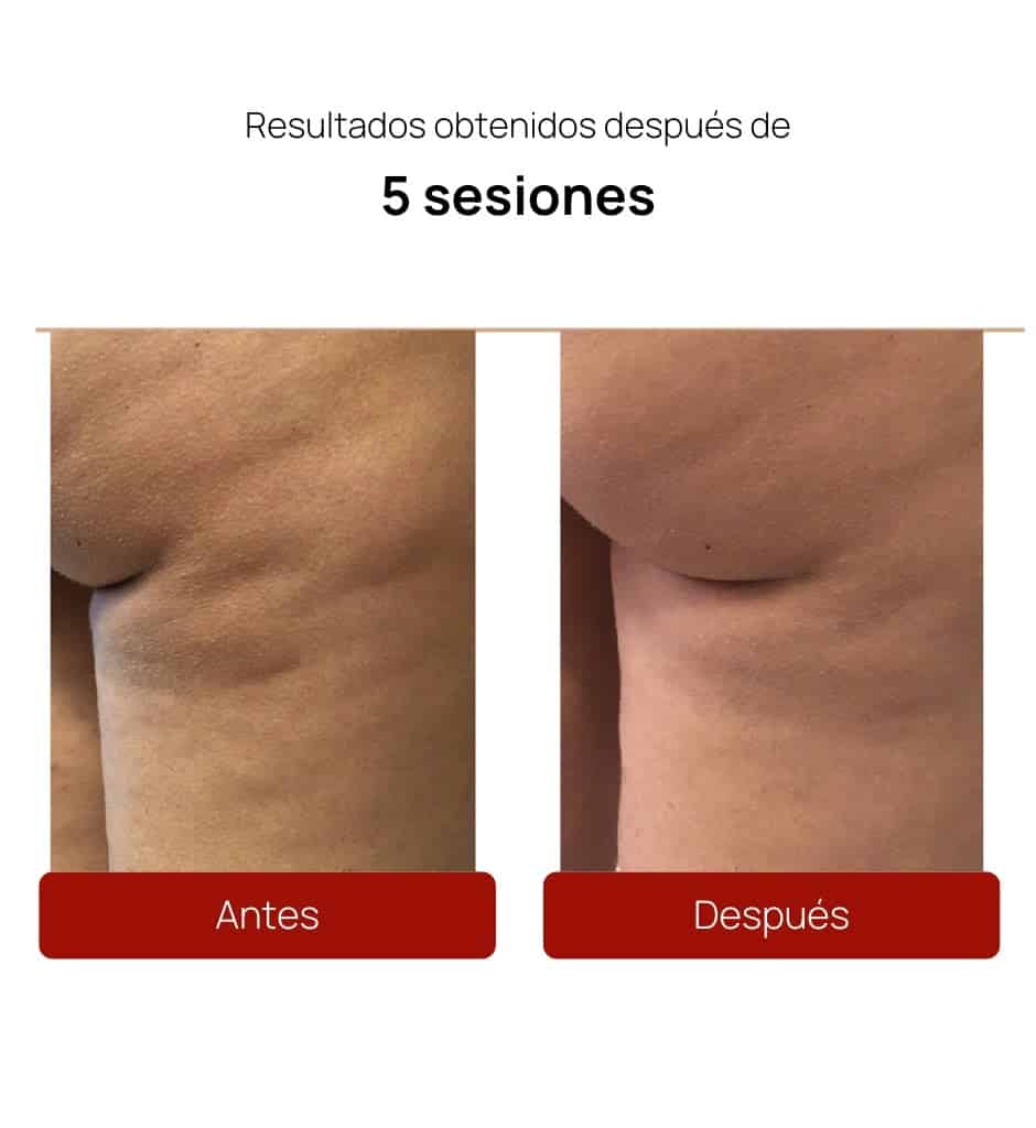 Antes y después Alidya